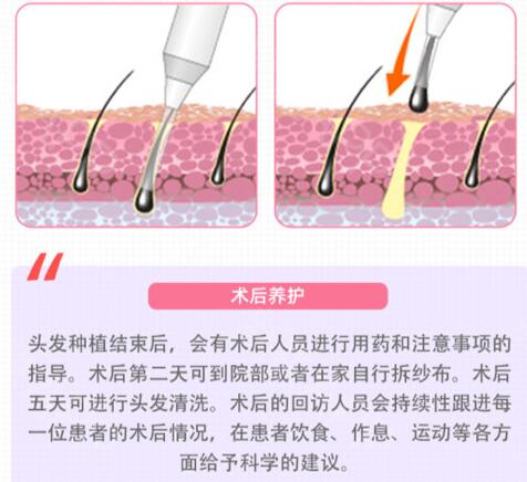 国内植发机构碧莲盛科普