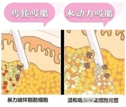 吸脂容易反弹吗?