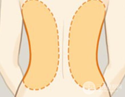 背部吸脂有几个部位?
