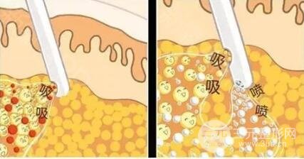与运动和药物减肥相比，背部吸脂术有以下优点