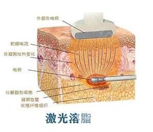 激光溶脂瘦脸恢复期注意事项有哪些?