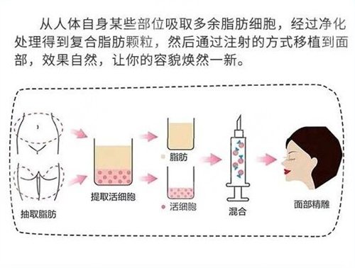 面颊部填充多少钱?