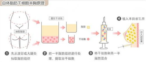 面部填充的方式