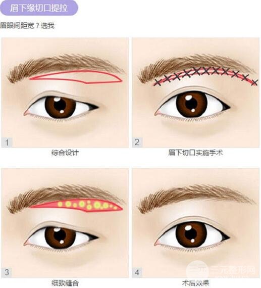 提眉术 眼下切口法
