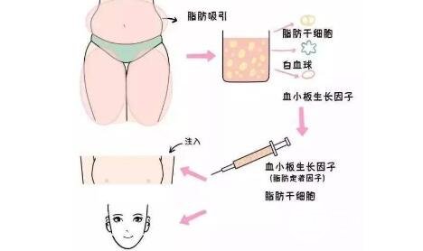 脂肪填充面部可以维持多久?