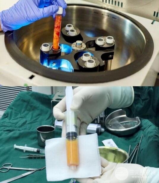 面部脂肪填充的后遗症是什么?