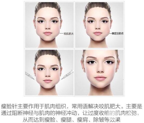 注射瘦脸