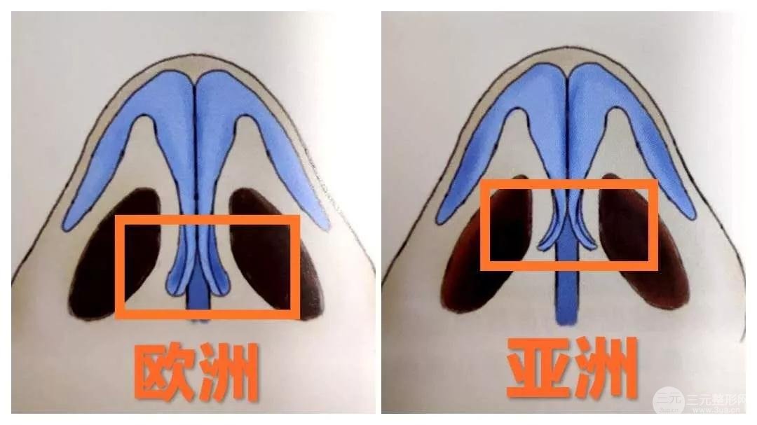 鼻小柱差异对比