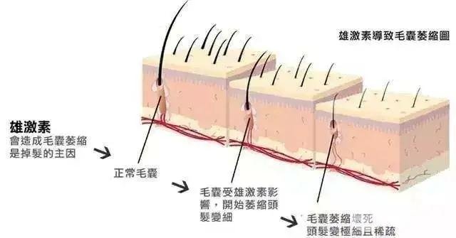 “雄秃”不只是男士才有