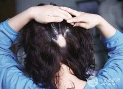 “鬼剃头”，到底是碰到了什么鬼?