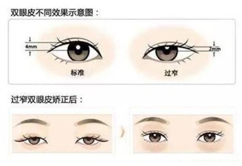 双眼皮案例