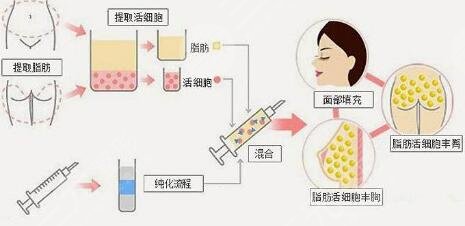 全脸脂肪填充手术原理