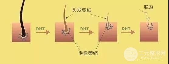 雄性脱发的原因