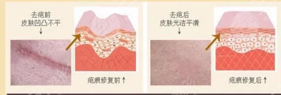 像素激光去疤痕的原理