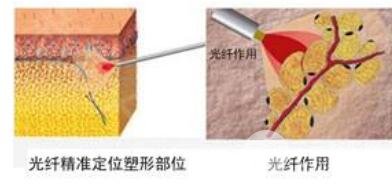 光纤溶脂有什么优点?