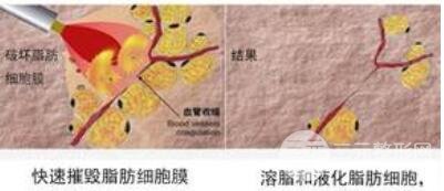 光纤溶脂有什么优点?