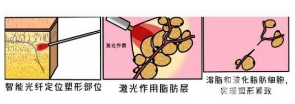 光纤溶脂术果怎么样?手术第3天有果吗?