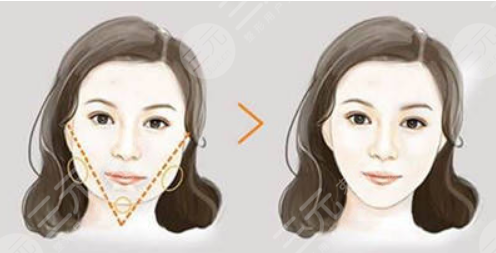 光纤溶脂术瘦脸案例术后30天