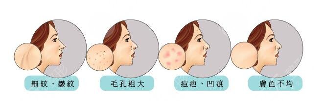 飞梭镭射的手术原理