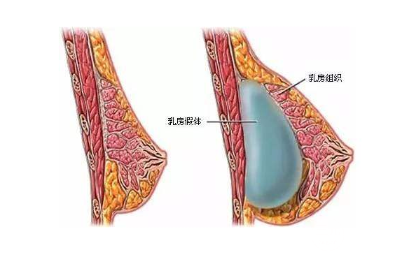 丰胸后遗症