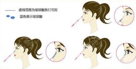 注射玻尿酸原理
