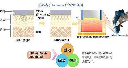 热玛吉原理和果简介
