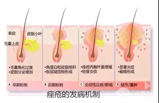 痘痘的成因