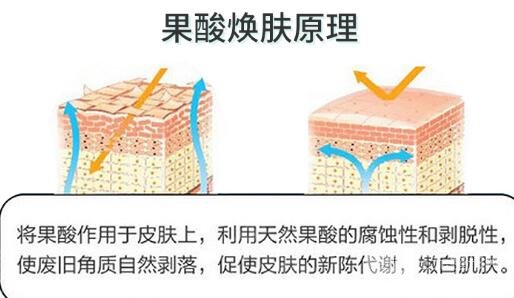 果酸焕肤