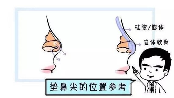 鼻尖塑形手术果