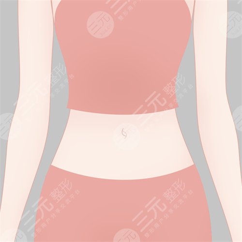 腰腹吸脂案例