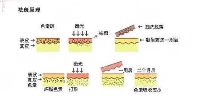 激光祛斑手术需要做几次