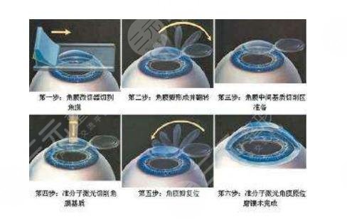 全飞秒近视矫正还会近视吗
