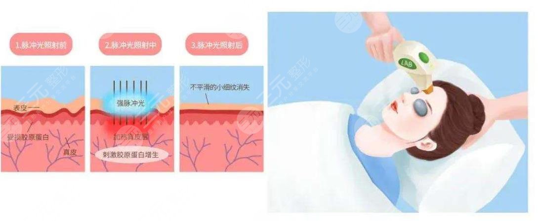 光子嫩肤