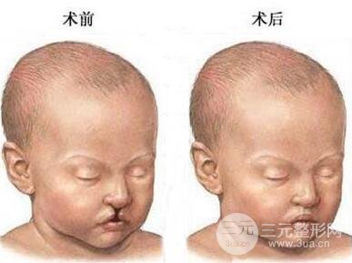 兔唇整形手术修复多少钱?需要修复几次？