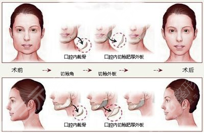 方脸的改善方式