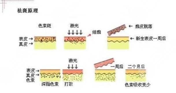 激光祛斑