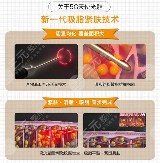 南京连天美医院科普吸脂手术的原理与护理
