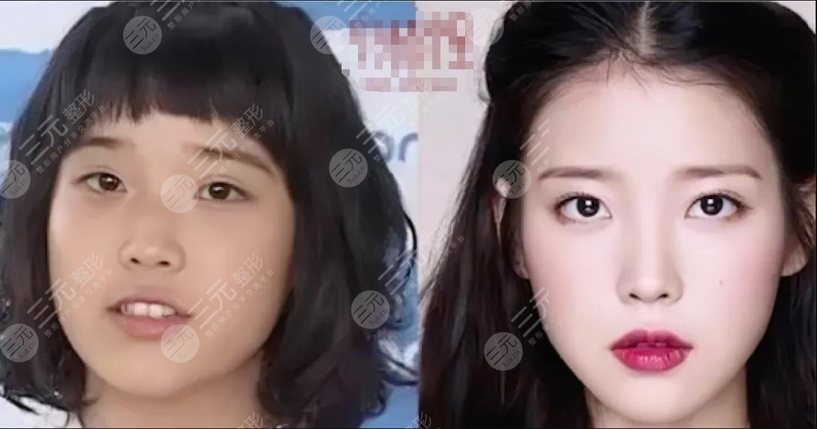 颜值分析|IU李知恩变美思路？不动骨微调也能变女神！整容史盘点！