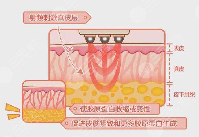 热玛吉