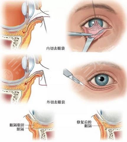 内切去眼袋