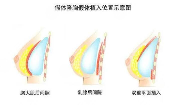 假体隆胸