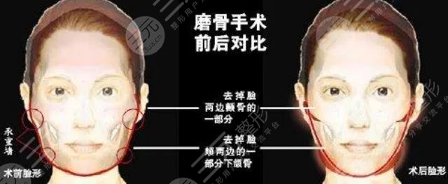 俞良钢磨下颌骨案例