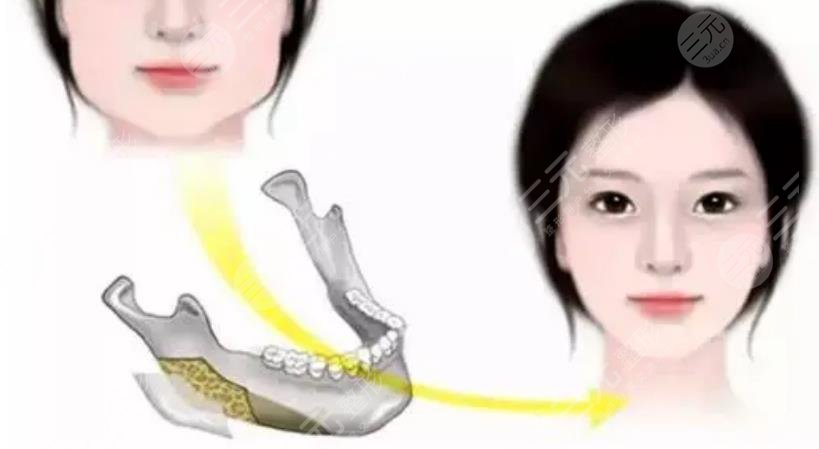 俞良钢磨下颌骨案例