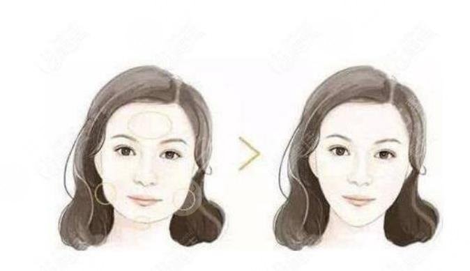 广州华美磨骨案例