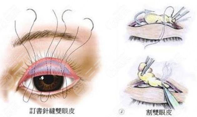 埋线双眼皮手术