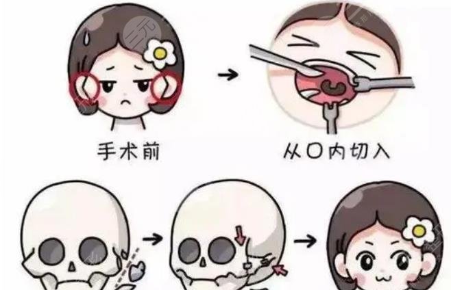 下颌角截骨手术的果