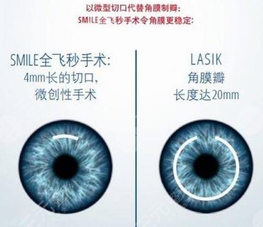 近视矫正手术