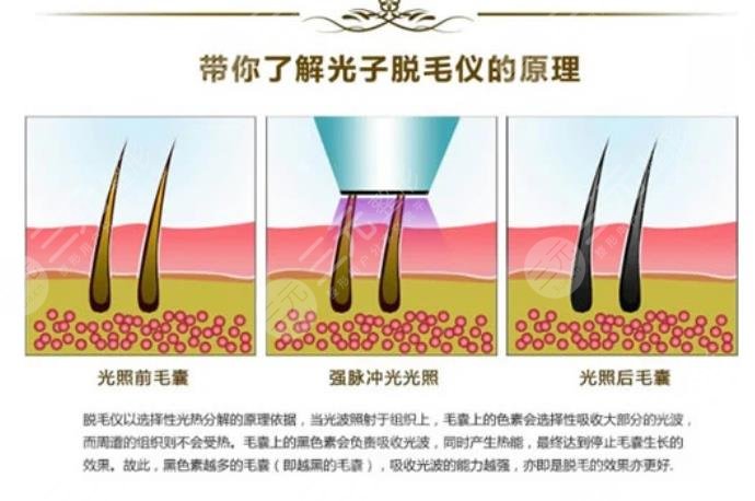 光子脱毛的原理