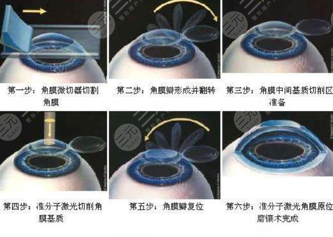 准分子激光手术的原理