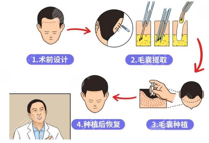 头发种植